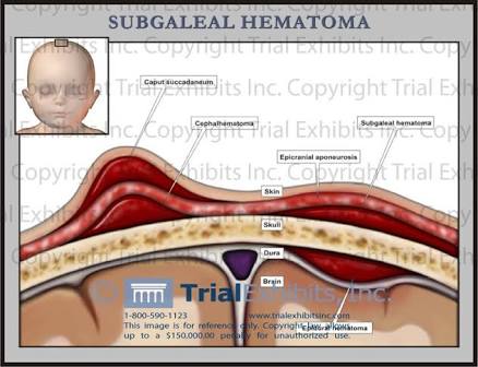 Subaponeurotic hemorrhage